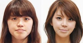 Kaip Pietų Korėjos plastikos chirurgai keičia žmonių išvaizdą (foto)
