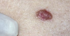 4 faktai apie dažniausiai diagnozuojamą odos vėžio formą – bazaliomą