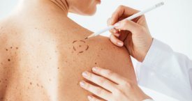 Melanoma serganti vilnietė: neįtariau, kad mažas apgamėlis baigsis tokia klastinga liga