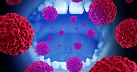 Onkologas: kaip lytinio gyvenimo pokyčiai keičia sergamumą burnos - gerklės vėžiu?