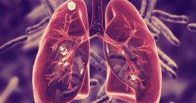 6 simptomai, įspėjantys apie plaučių ligą