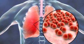 Klastinga liga – plaučių uždegimas: gydytoja įspėja apie galimus pavojus