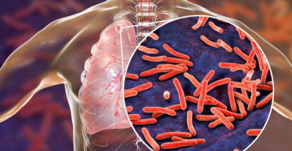 Tuberkuliozė – lėtas, tačiau labai pavojingas priešas