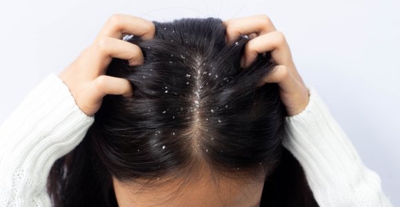 Nesudėtingos plaukų kaukės nuo pleiskanų