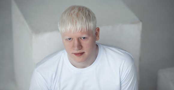 Tokie panašūs, tokie skirtingi: albinosai iš įvairių pasaulio kampelių (foto)