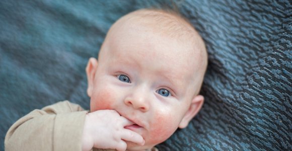 Atopinis dermatitas – mitais apipinta kas penktą kūdikį kamuojanti odos liga