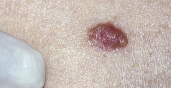 4 faktai apie dažniausiai diagnozuojamą odos vėžio formą – bazaliomą