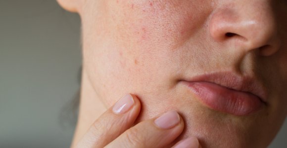 10 klausimų dermatovenerologei Dailei Malinauskaitei apie veido rožinę