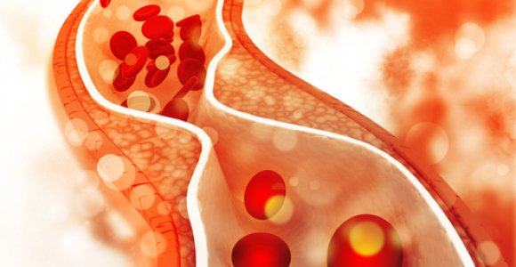 Padidėjęs cholesterolis: kokią įtaką tam daro karantinas