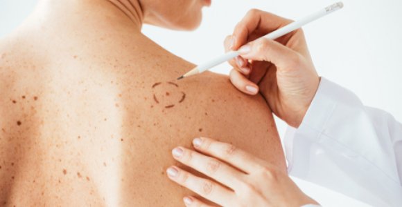 Melanoma serganti vilnietė: neįtariau, kad mažas apgamėlis baigsis tokia klastinga liga