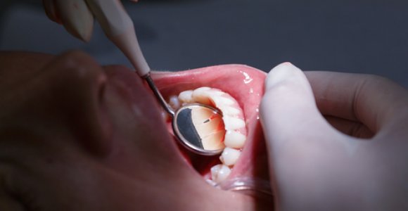 Sužinokite, ką apie mūsų organizmą pasako dantų būklė