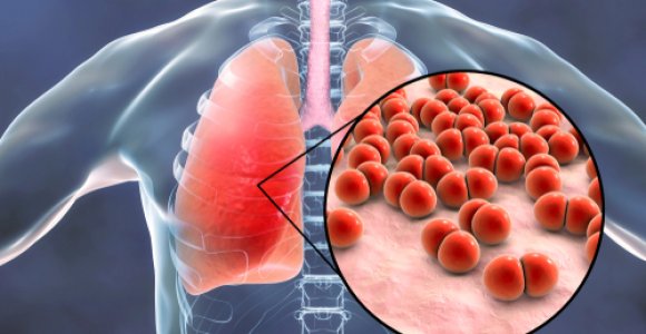 Klastinga liga – plaučių uždegimas: gydytoja įspėja apie galimus pavojus