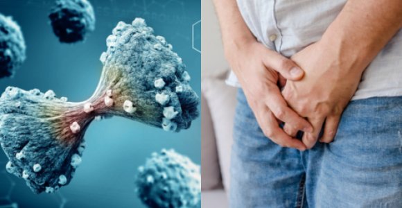 Vyrų žudikas – prostatos vėžys: į kokius ženklus svarbiausia atkreipti dėmesį?