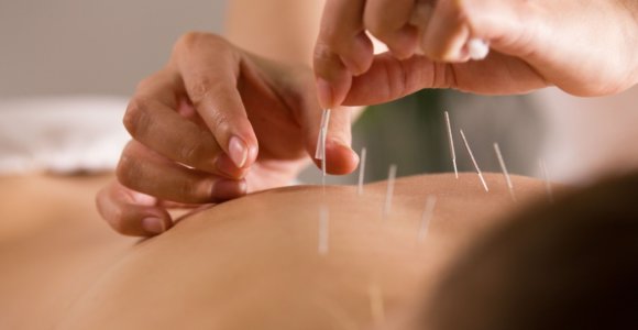 Akupunktūra – biologiškai aktyvių kūno taškų stimuliavimas