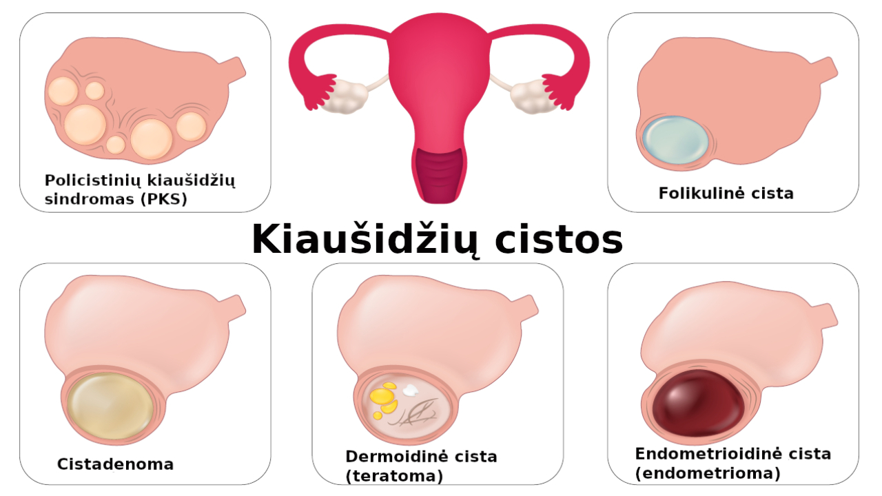 Dažniausi kiaušidžių cistų tipai