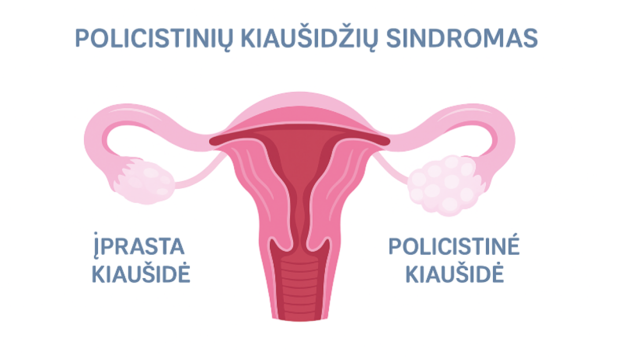 Policistinių kiaušidžių sindromas (PKS) – hormonų pusiausvyros sutrikimas,