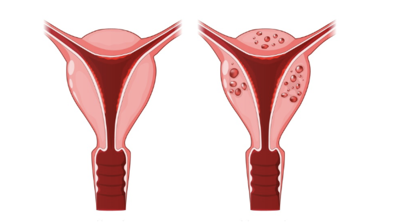 Adenomiozė – ginekologinė liga, kai gimdos gleivinė auga į gimdos raumeninį sluoksnį.
