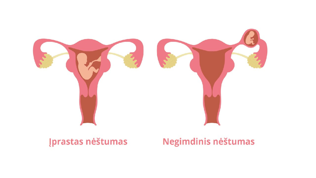 Negimdinis nėštumas – pavojinga būklė, kai vaisius vystosi ne gimdoje