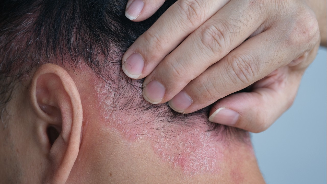 Seborejinis dermatitas – lėtinis odos uždegimas.