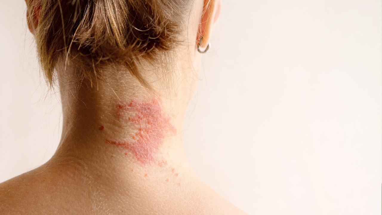 Atopinis dermatitas – lėtinis odos uždegimas.