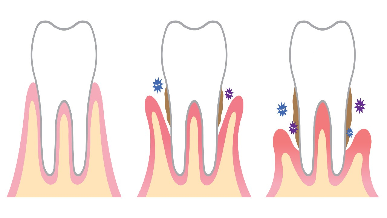 Periodontitas – dantenų ir dantų tvirtinamojo audinio uždegimas.