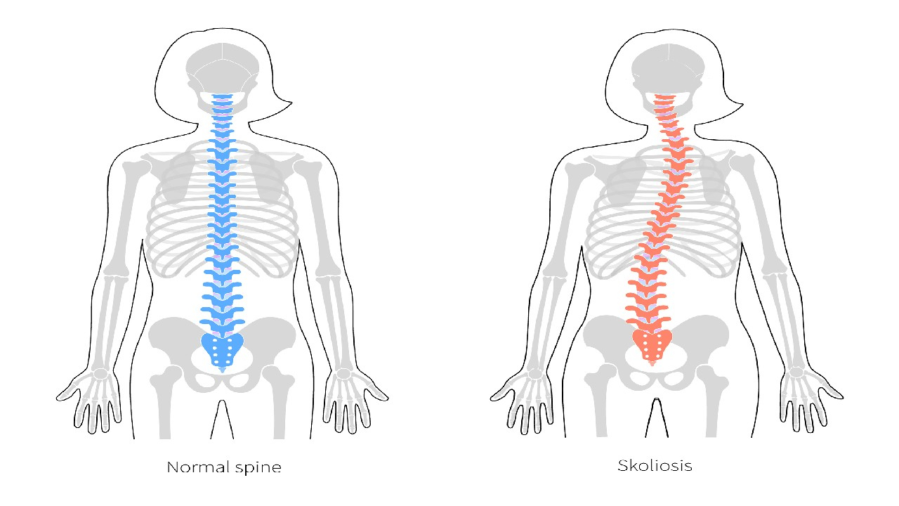 Skoliozė – stuburo šoninis išlinkimas, pažeidžiantis laikyseną.