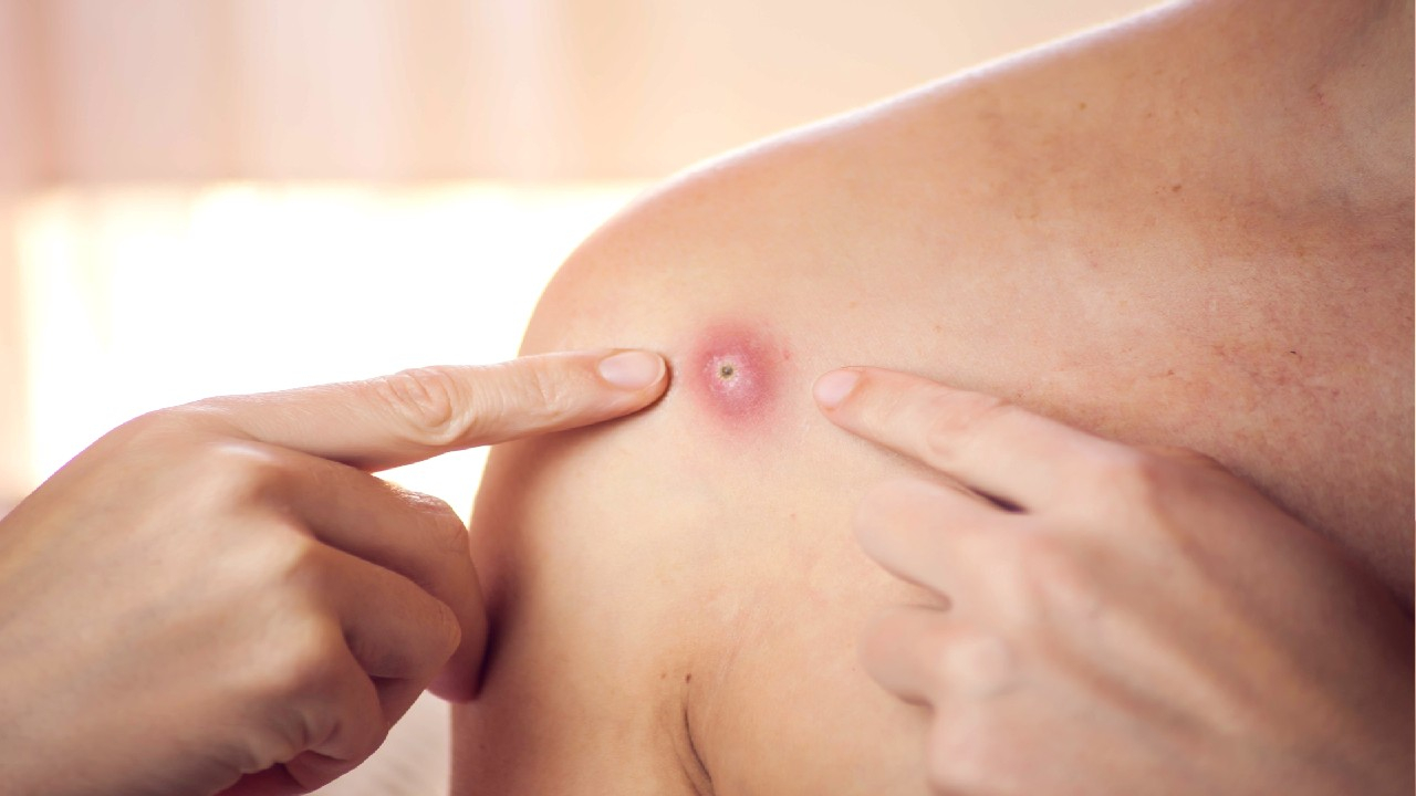 Abscesas – lokalizuotas pūlinys, susidarantis dėl infekcijos ir uždegimo audiniuose.