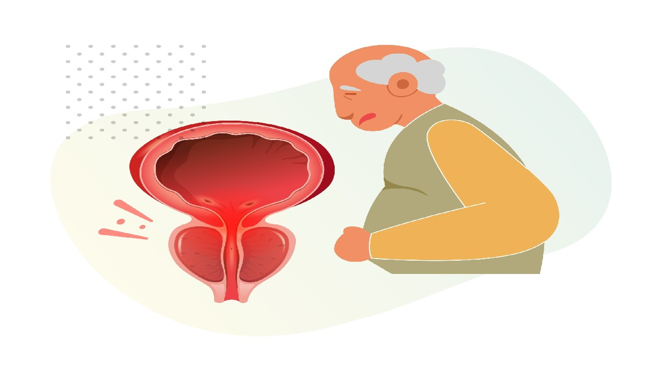 Prostatos vėžys – piktybinis navikas prostatos liaukoje.