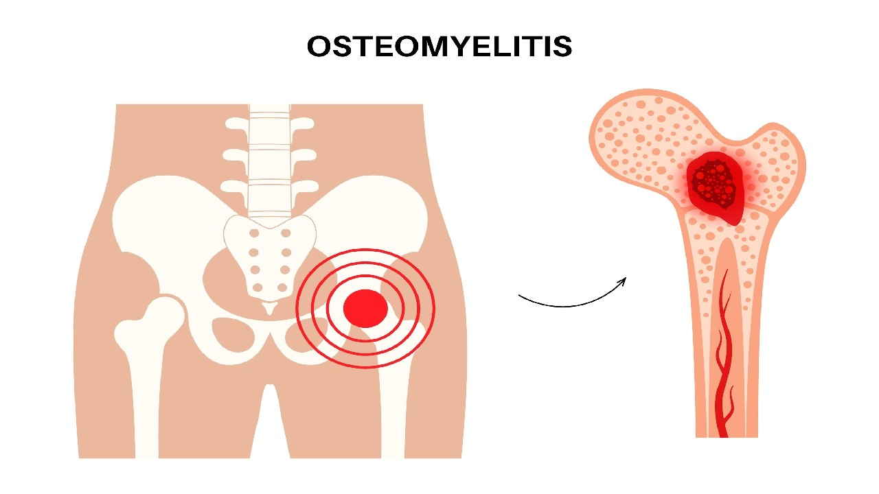 Osteomielitas – infekcinis kaulo uždegimas, sukeliantis skausmą, tinimą ir pūliavimą.