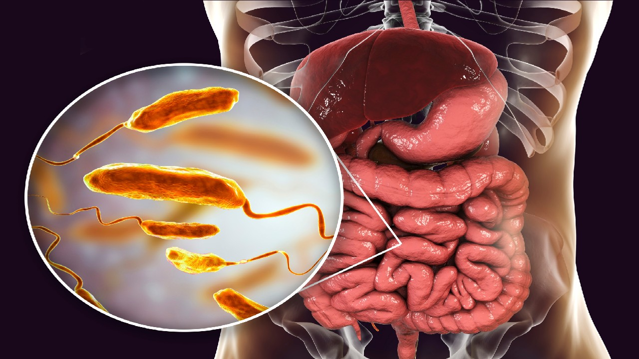Cholera – ūmi žarnyno infekcija.