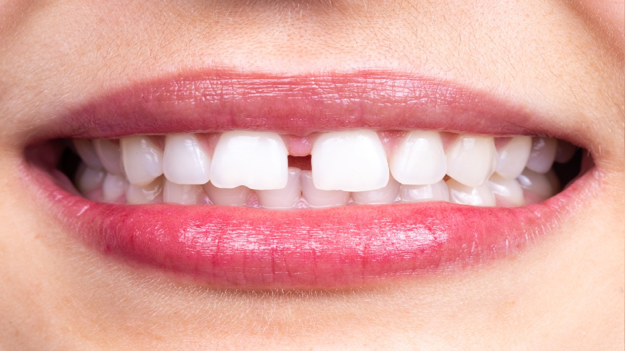 Diastema – tarpas tarp dantų, dažniausiai priekinių.