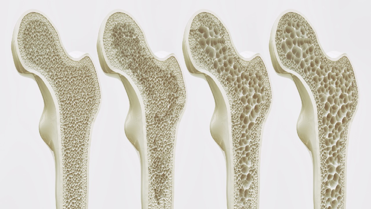Osteoporozė – kaulų retėjimo liga.