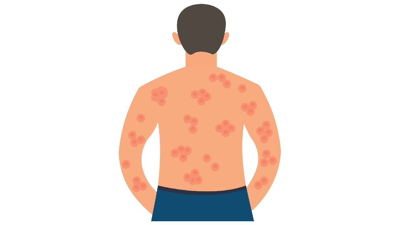 Dermatomiozitas – autoimuninė liga, sukeliančianti raumenų uždegimą ir odos bėrimus.