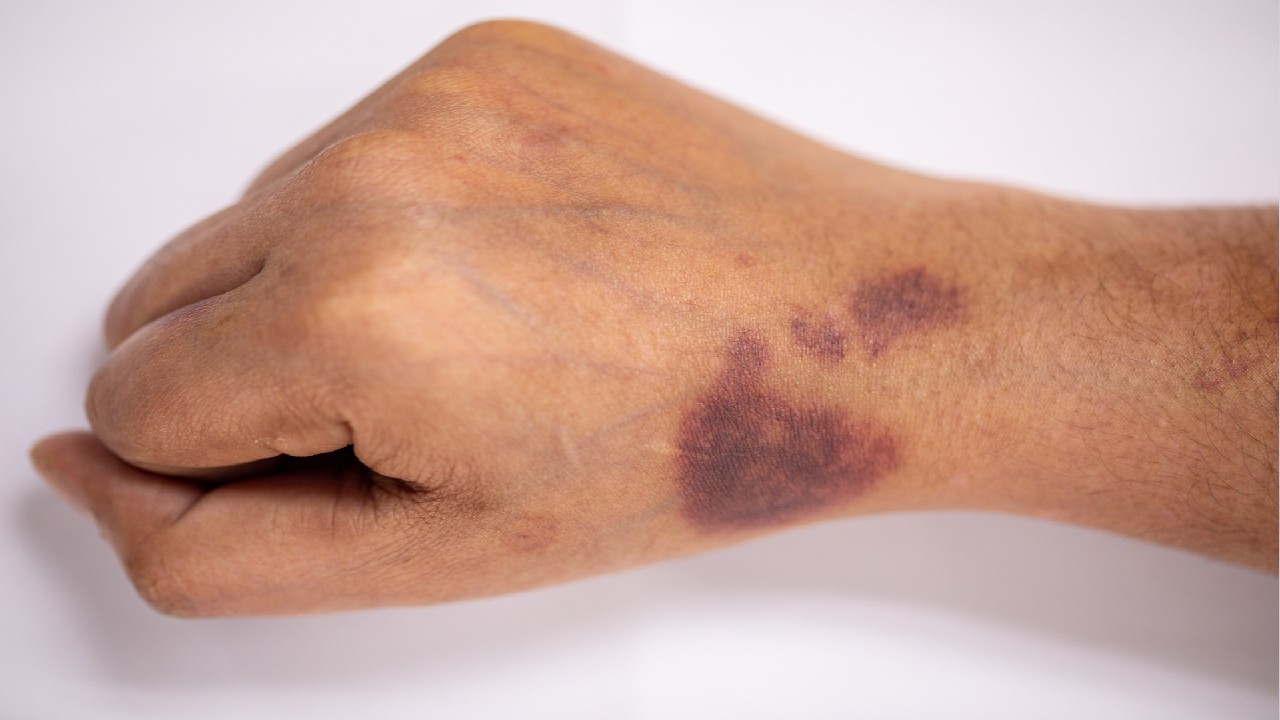 Hemofilija – tai paveldimas kraujo krešėjimo sutrikimas.