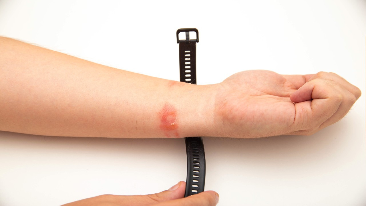 Alerginis kontaktinis dermatitas – odos uždegimas, atsirandantis dėl alerginės reakcijos į tiesioginį sąlytį su tam tikra medžiaga.