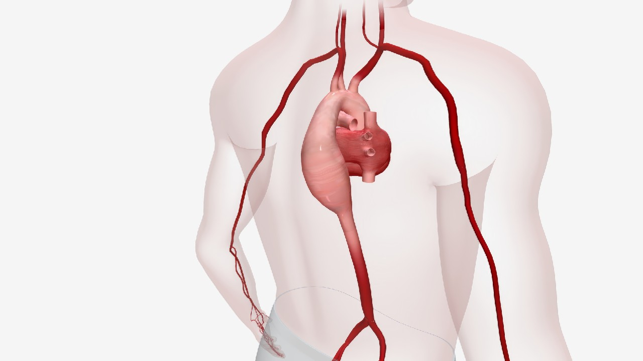 Aortos aneurizma – tai aortos sienelės išsiplėtimas, kuris gali sukelti gyvybei pavojingą plyšimą, todėl reikalauja ankstyvos diagnozės ir priežiūros.