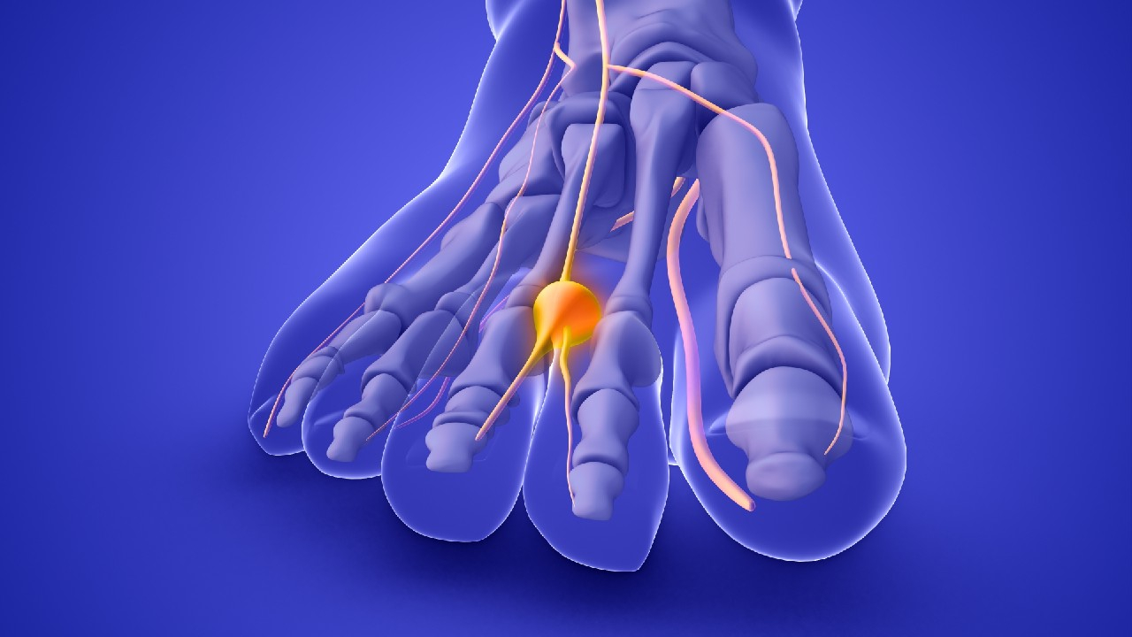 Mortono neuroma – tai pėdos nervo sustorėjimas, sukeliantis skausmą, deginimą ar tirpimą, dažniausiai tarp trečio ir ketvirto piršto. 