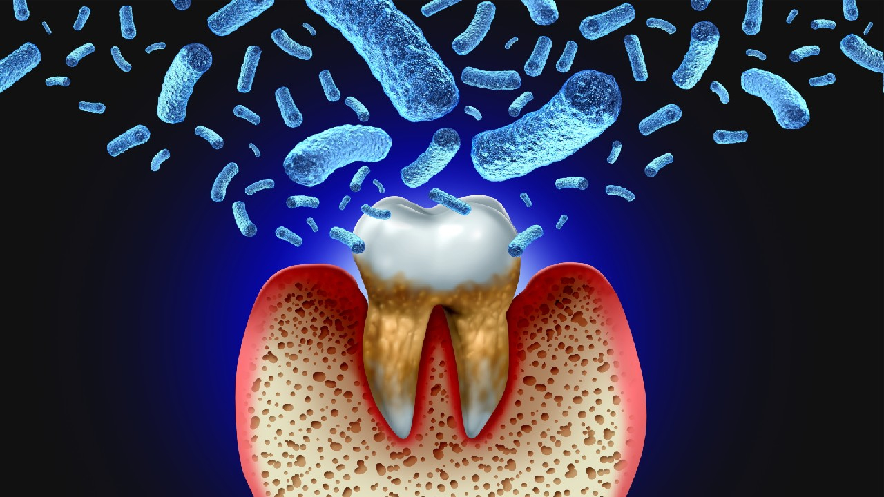 Parodontozė – tai lėtinis dantenų ir periodonto audinių uždegimas, galintis sukelti dantenų atsitraukimą, kraujavimą ir dantų netekimą.