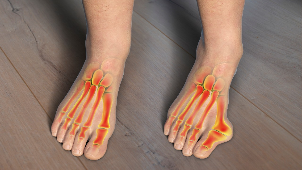 Hallux valgus – tai pėdos deformacija, kai didysis kojos pirštas nukrypsta į išorę, o prie sąnario formuojasi iškrypimas (vadinamas „kauliuku“).