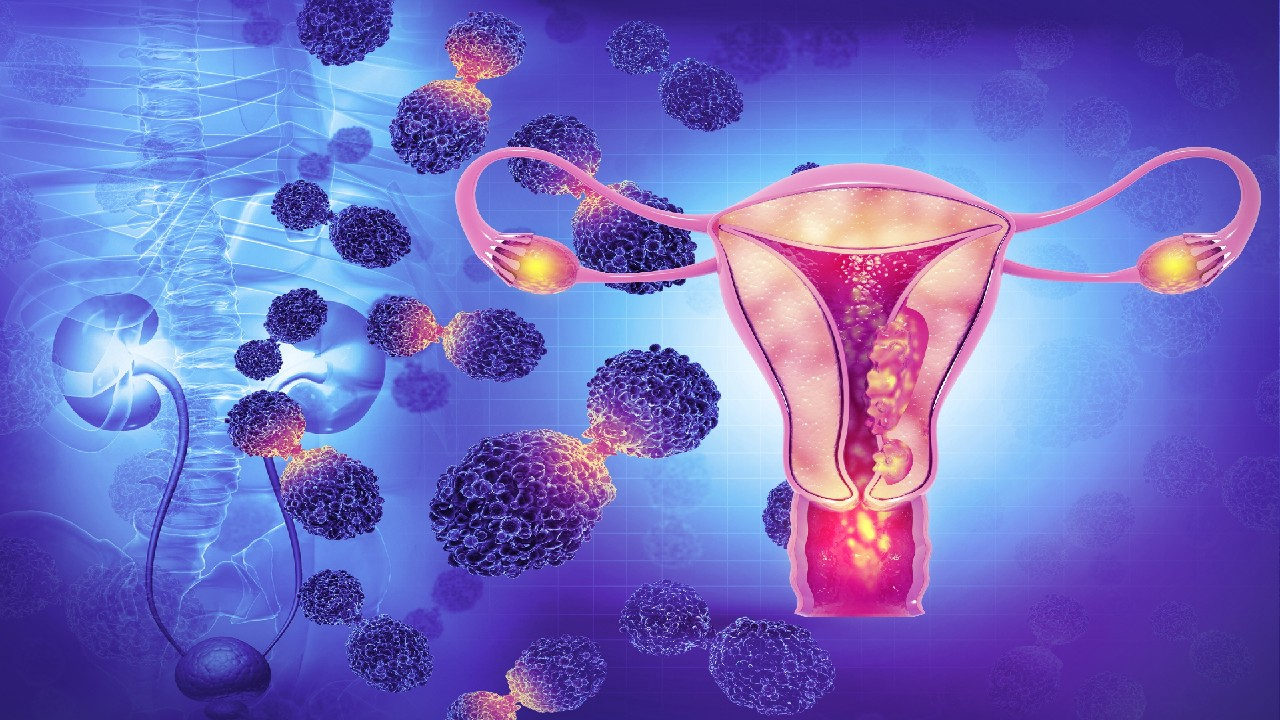 Gimdos kūno vėžys – tai piktybinis gimdos gleivinės (endometriumo) auglys, dažniausiai pasireiškiantis vyresnio amžiaus moterims.