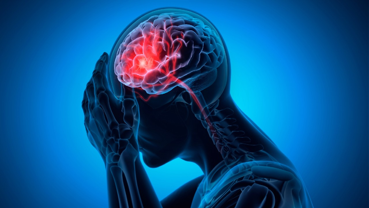 Galvos smegenų aneurizma – tai smegenų kraujagyslės išsiplėtimas, kuris gali sukelti plyšimą, kraujavimą ir rimtus neurologinius sutrikimus.