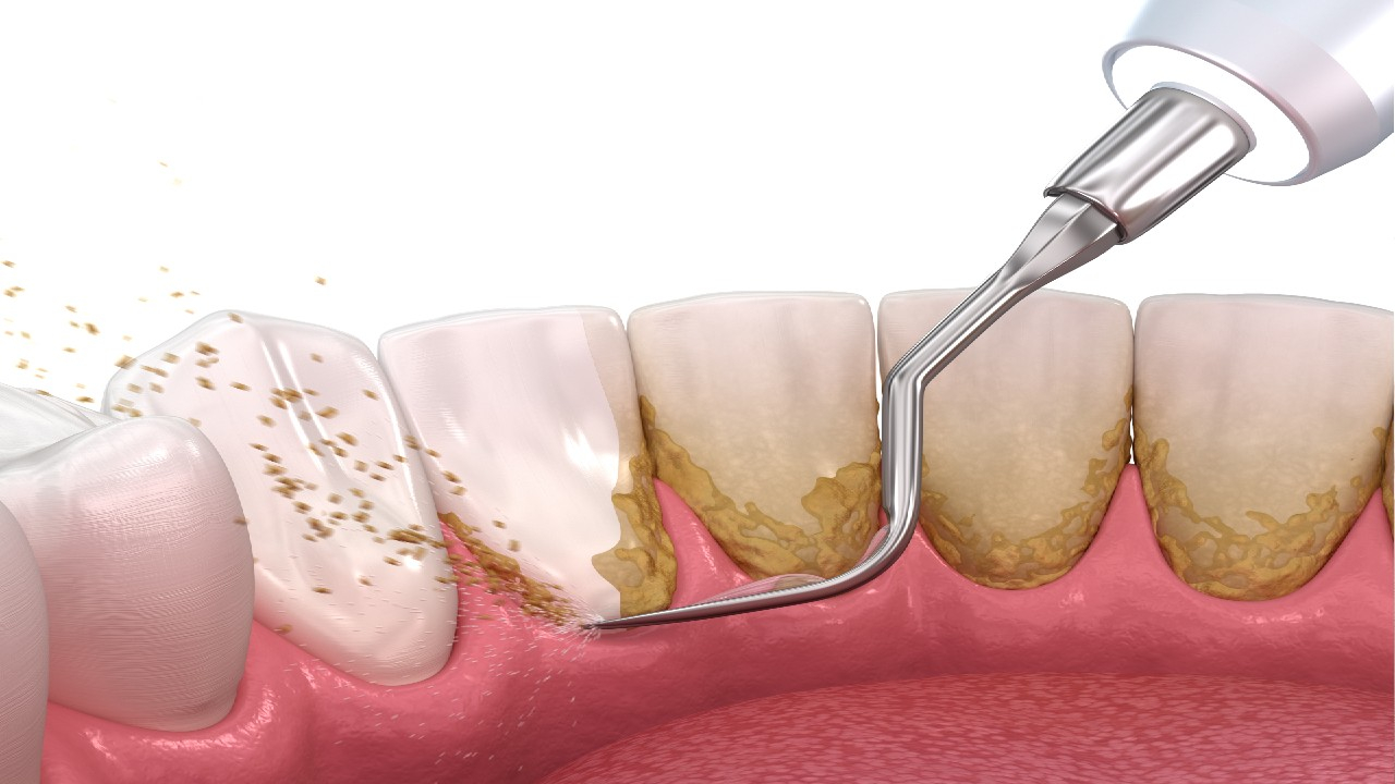 Bakterinis gingivitas – tai dantenų uždegimas, kurį sukelia ant dantų susikaupusios bakterinės apnašos.