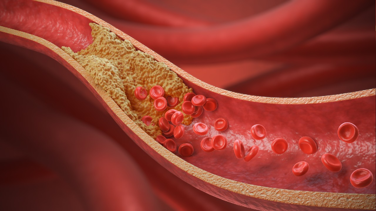 Cholesterolio padidėjimas – tai būklė, kai kraujyje padidėja cholesterolio kiekis, galintis sutrikdyti kraujagyslių veiklą ir didinti širdies ligų riziką.
