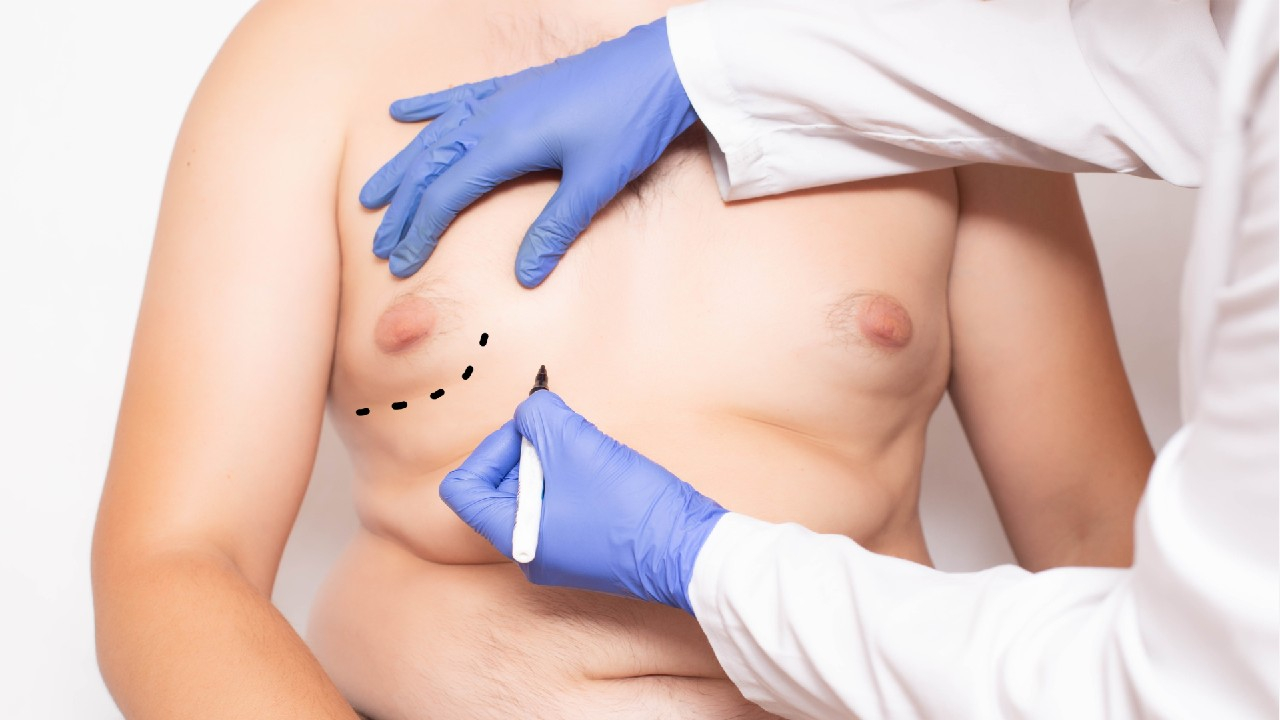 Ginekomastija – tai gerybinis vyrų krūties liaukinio audinio padidėjimas, atsirandantis dėl hormonų pusiausvyros sutrikimo.