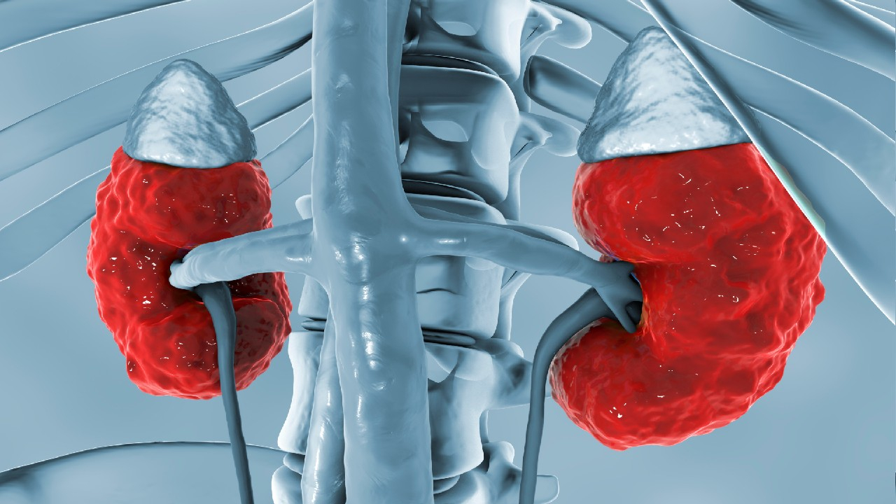 Lėtinis glomerulonefritas – tai ilgalaikis inkstų glomerulų uždegimas, kuris palaipsniui pažeidžia inkstų audinį ir silpnina jų funkciją.
