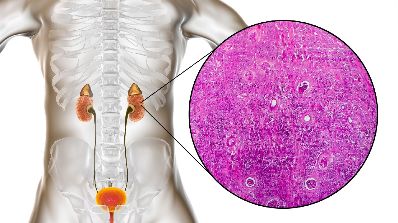 Ūminis glomerulonefritas – tai staiga prasidedantis inkstų glomerulų uždegimas, sukeliantis šlapimo pokyčius, tinimus ir kraujospūdžio padidėjimą.