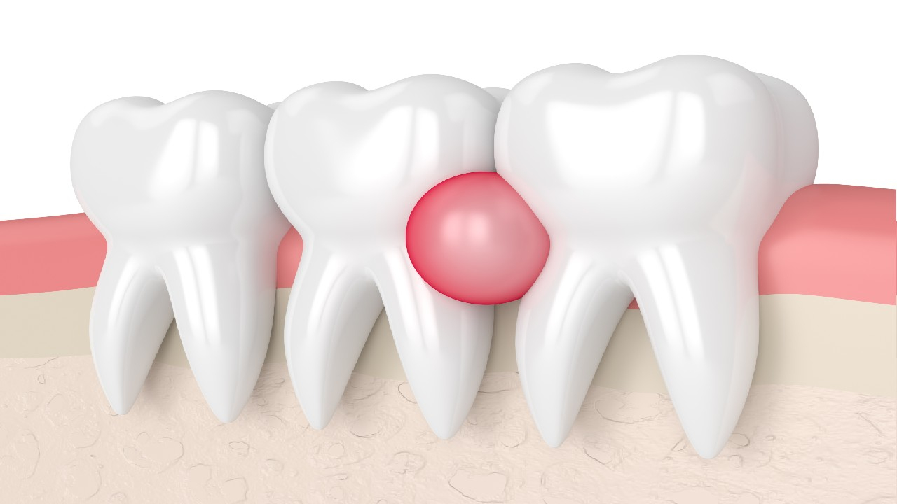 Periodontalinis abscesas – tai pūlinys, susiformuojantis dantenų ir periodonto audiniuose šalia danties dėl infekcijos ir uždegimo.